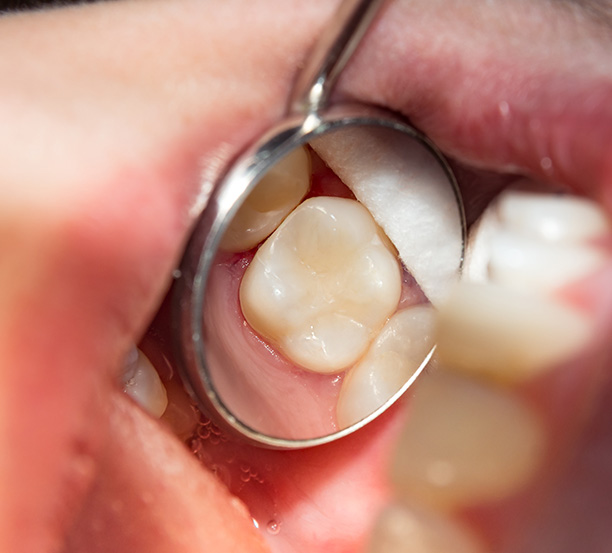 Sunset Dental | Preventative Program, Dental Sealants and Inlays  amp  Onlays